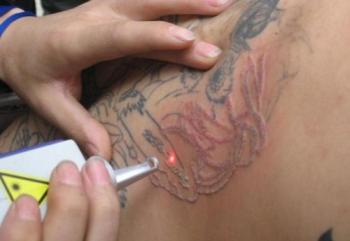 Как удалить татуировку