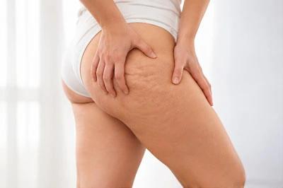 Корекція фігури VelaShape в Одесі при проявах целюліту